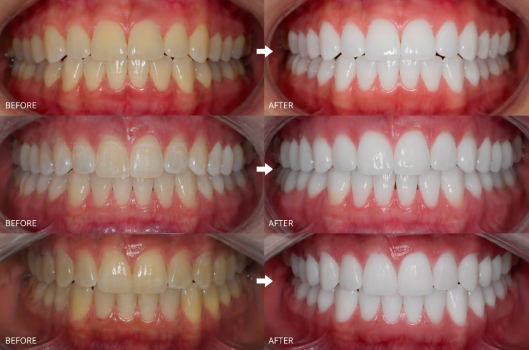 Before and after whitening placeholder