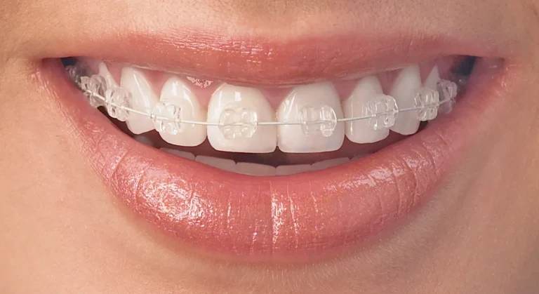 Close-up of teeth with ceramic braces