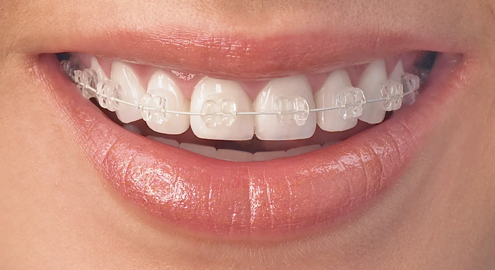 Ceramic Braces